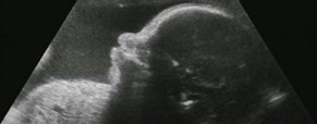 Abortion